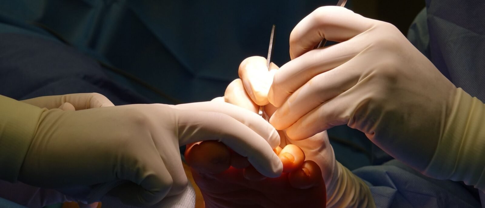 Mãos enluvadas realizando delicada cirurgia de pé em ambiente estéril de operação